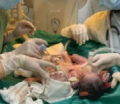 Bebês siameses unidos pelo abdômen nascem em Goiânia